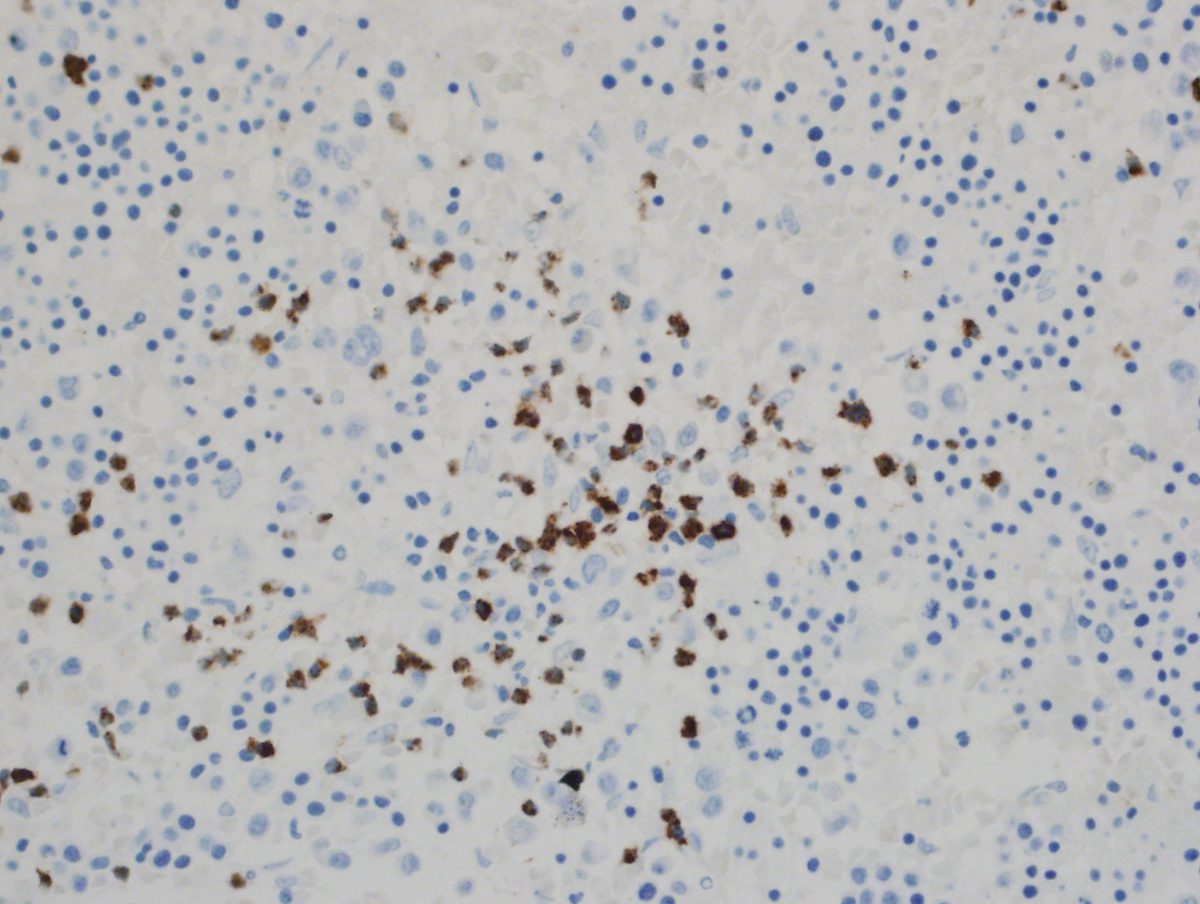 Bone Marrow Biopsy, Pax 5, 40X